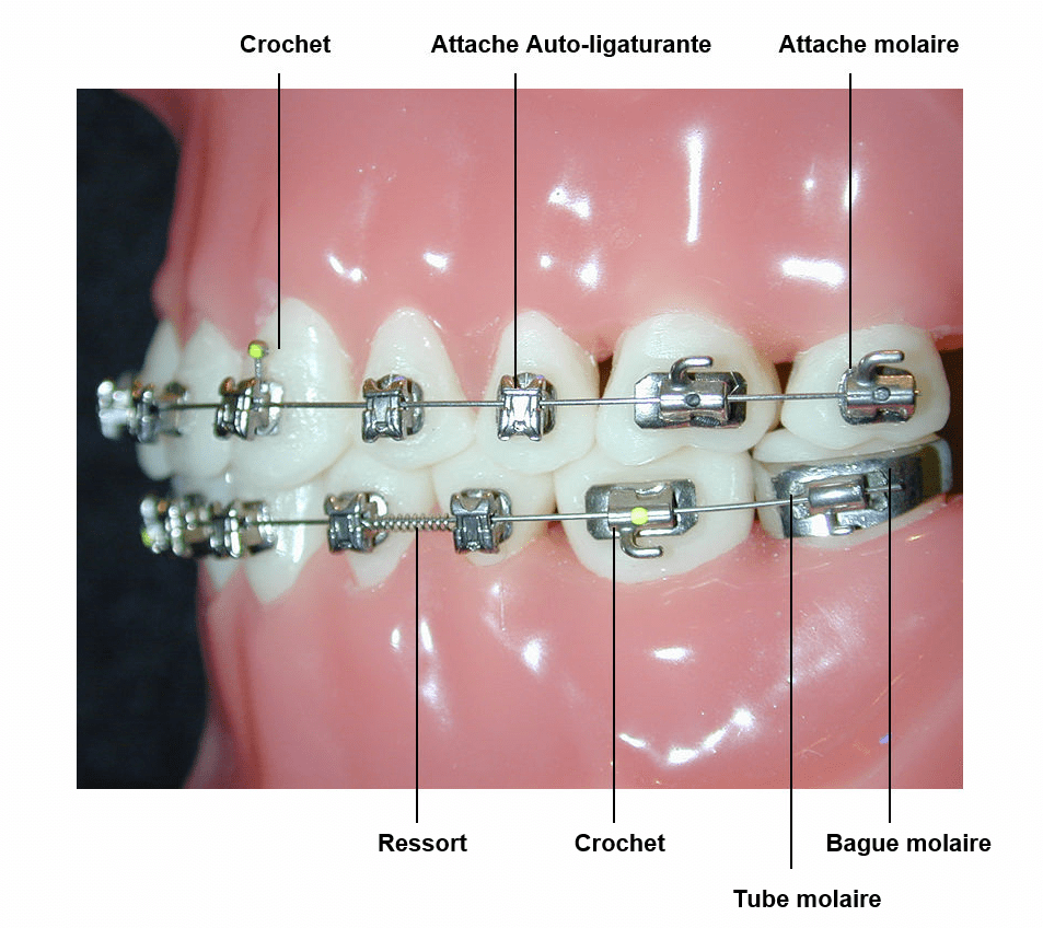 Système multi-attaches autoligaturant (métal ou céramique)