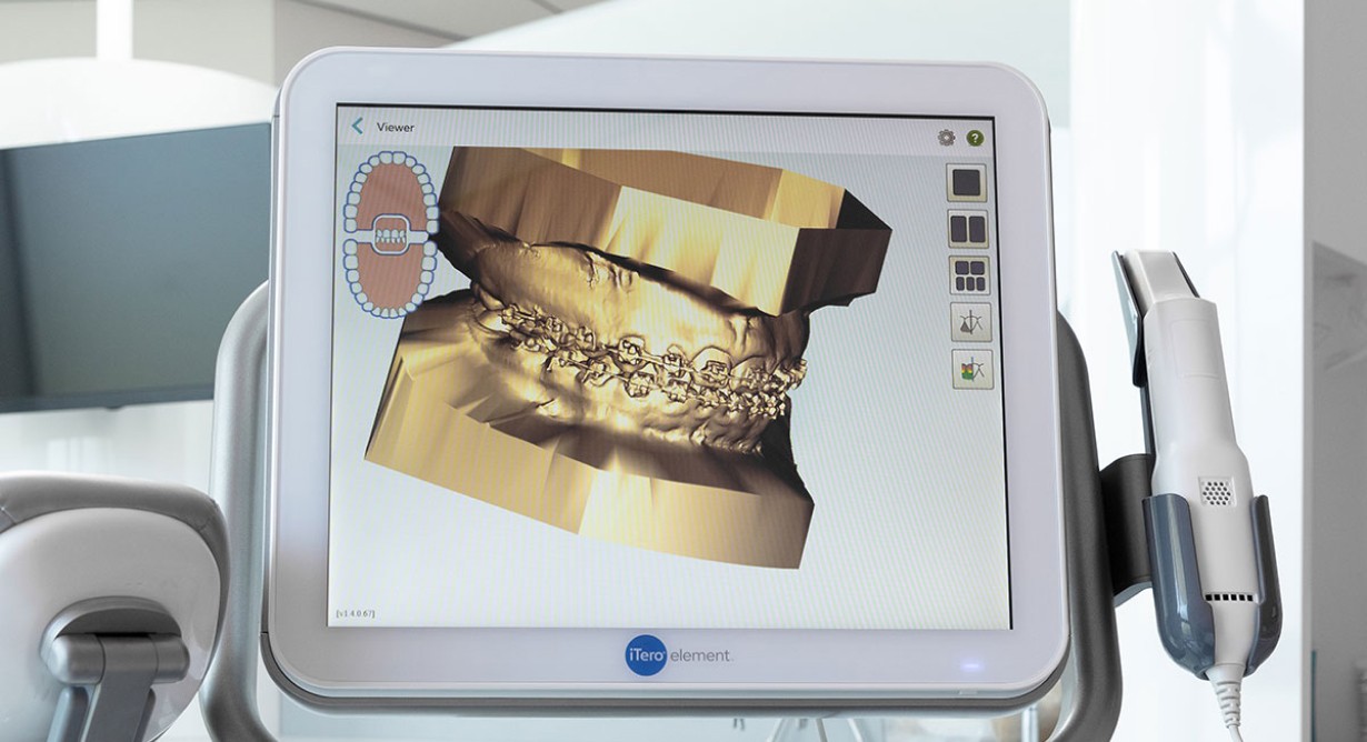 Orthodontiste Molsheim Dr Vincent Robert Empreinte optique