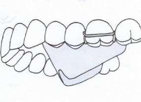 Orthodontiste Molsheim Dr Vincent Robert Enveloppe linguale nocturne