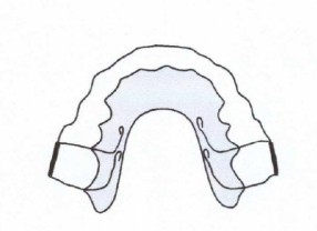 Orthodontiste Molsheim Dr Vincent Robert plaque amovible