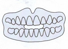 Orthodontiste Molsheim Dr Vincent Robert positionneur