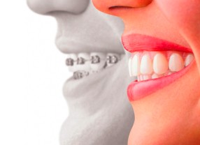 Dr Vincent Robert orthodontiste conseil systheme multi-attaches
