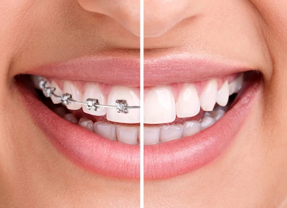 Traitement orthodontique