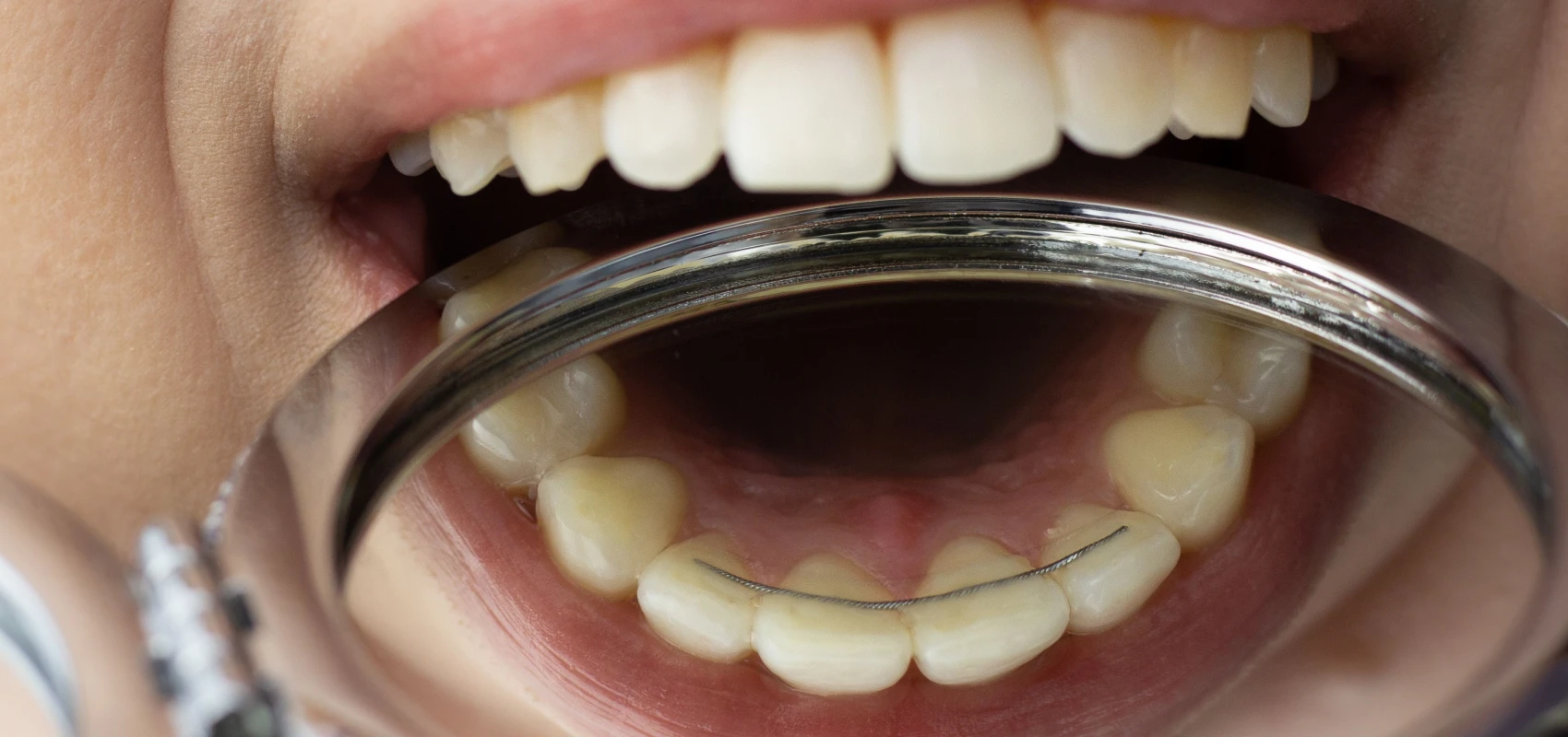 Les fils colles derrière les dents