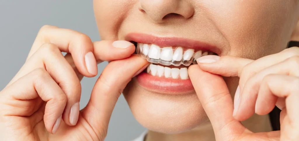 gouttiere invisible Orthodontiste Molsheim