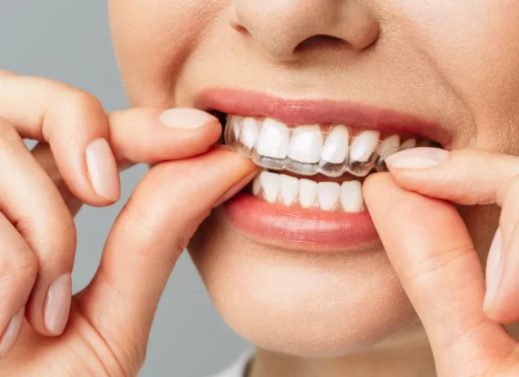 gouttiere invisible Orthodontiste Molsheim