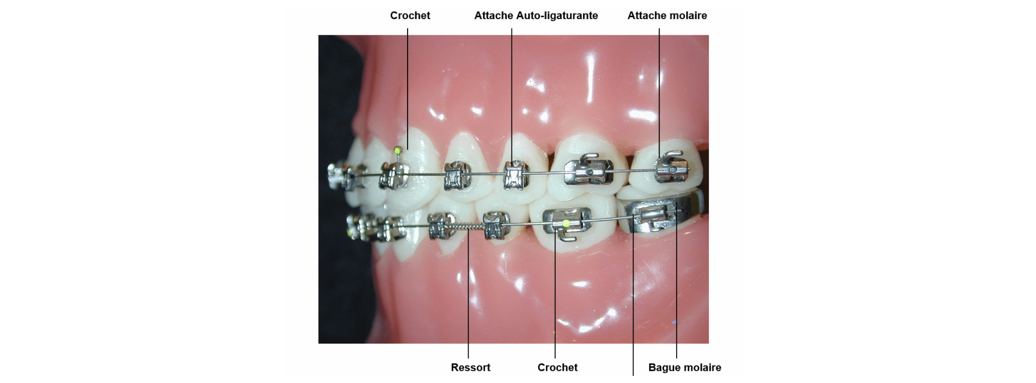Système multi-attaches autoligaturant