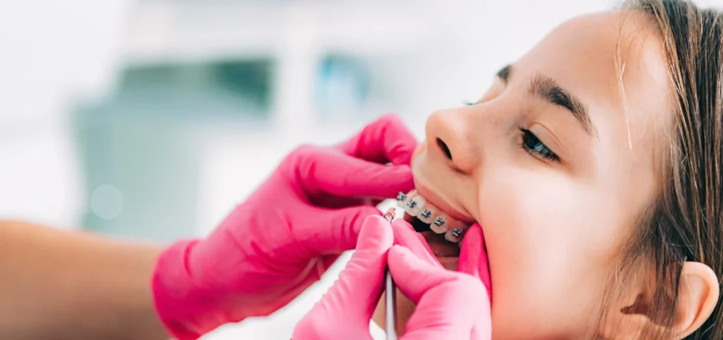 orthodontie adolescent multi attaches Orthodontiste Molsheim