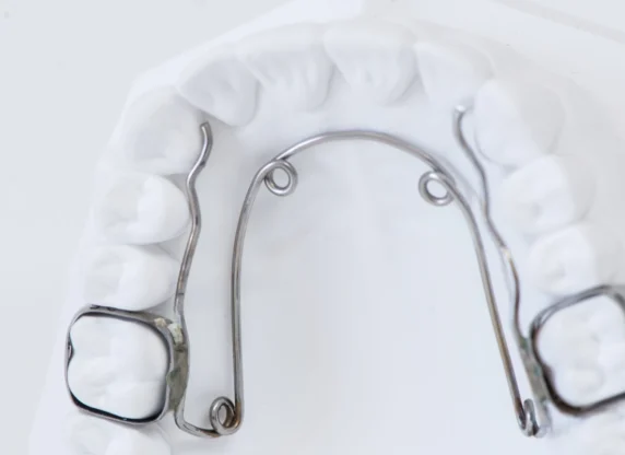 orthodontie quadhelix Orthodontiste Molsheim
