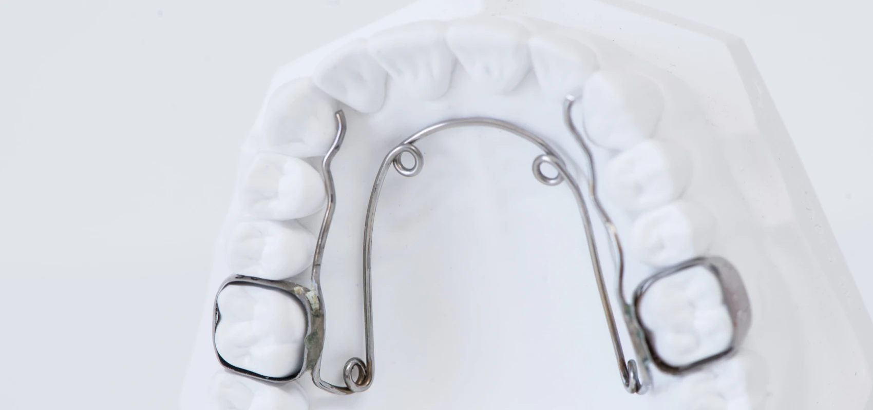orthodontie quadhelix Orthodontiste Molsheim