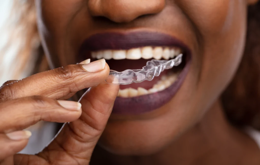 contention dentaire schirmeck traitement contention dentaire schirmeck traitement Orthodontiste près d'Entzheim : aligneurs transparents et appareil multi-attaches au cabinet du Dr Vincent Robert Dr Vincent Robert | Orthodontiste à Molsheim