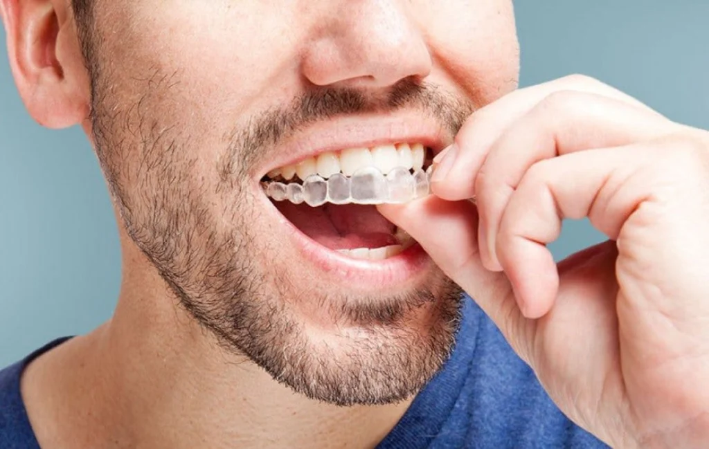 invisalign molsheim invisalign molsheim Orthodontiste près de Wasselonne : aligneurs transparents et appareil multi-attaches au cabinet du Dr Robert Dr Vincent Robert | Orthodontiste à Molsheim