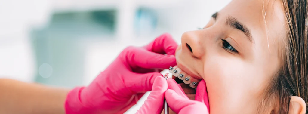 multi bagues adolescents molsheim multi bagues adolescents molsheim Orthodontiste près de Marlenheim : aligneurs transparents et appareil multi-attaches au cabinet du Dr Robert Dr Vincent Robert | Orthodontiste à Molsheim